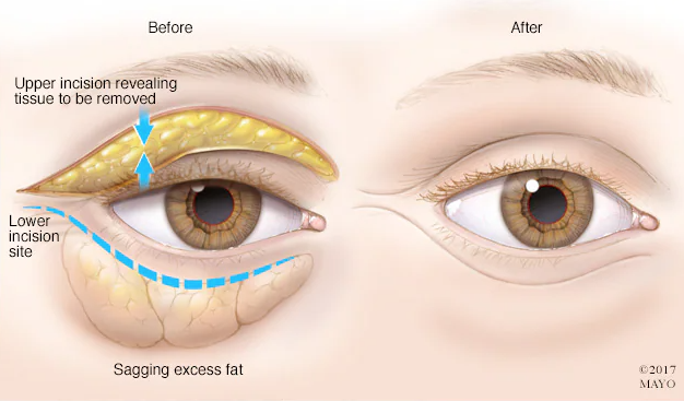How blepharoplasty is done 