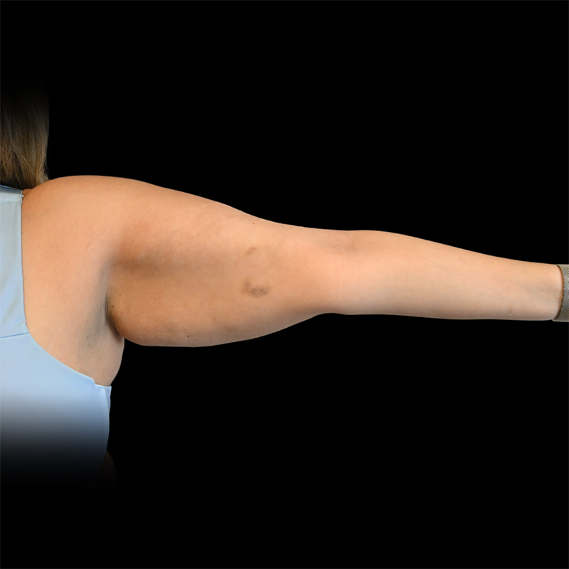 Arm Lift Before & After Image