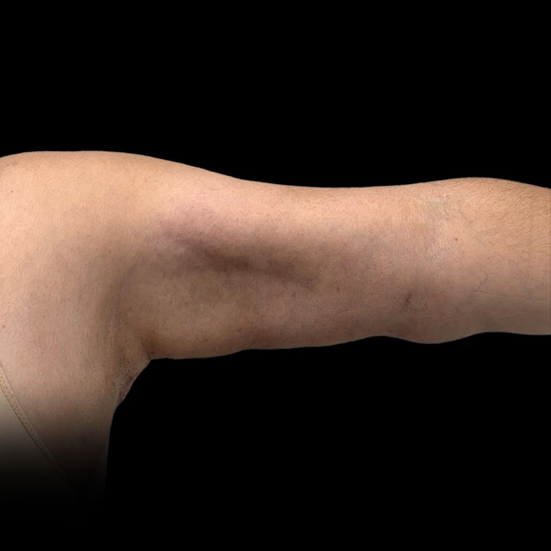 Arm Lift Before & After Image