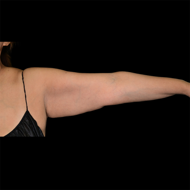 Arm Lift Before & After Image