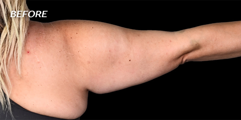 Arm Liposuction Before & After Image