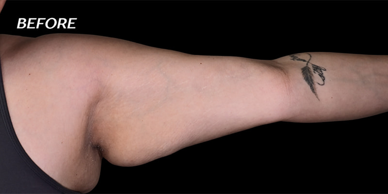 Arm Liposuction Before & After Image