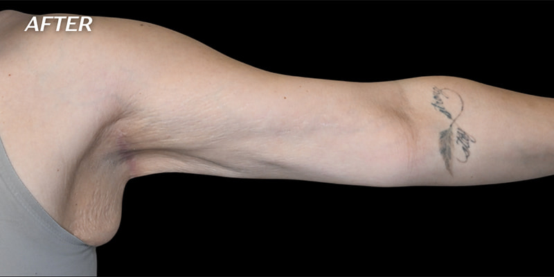 Arm Liposuction Before & After Image