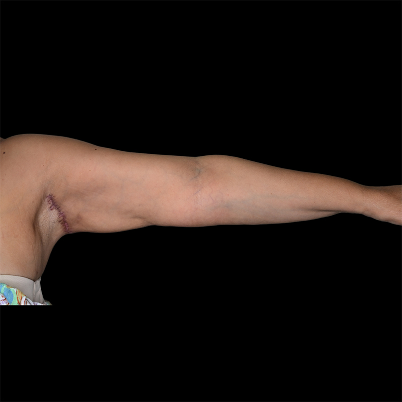 Arm Liposuction Before & After Image