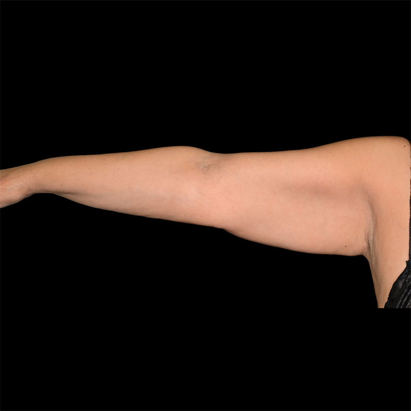 Arm Liposuction Before & After Image