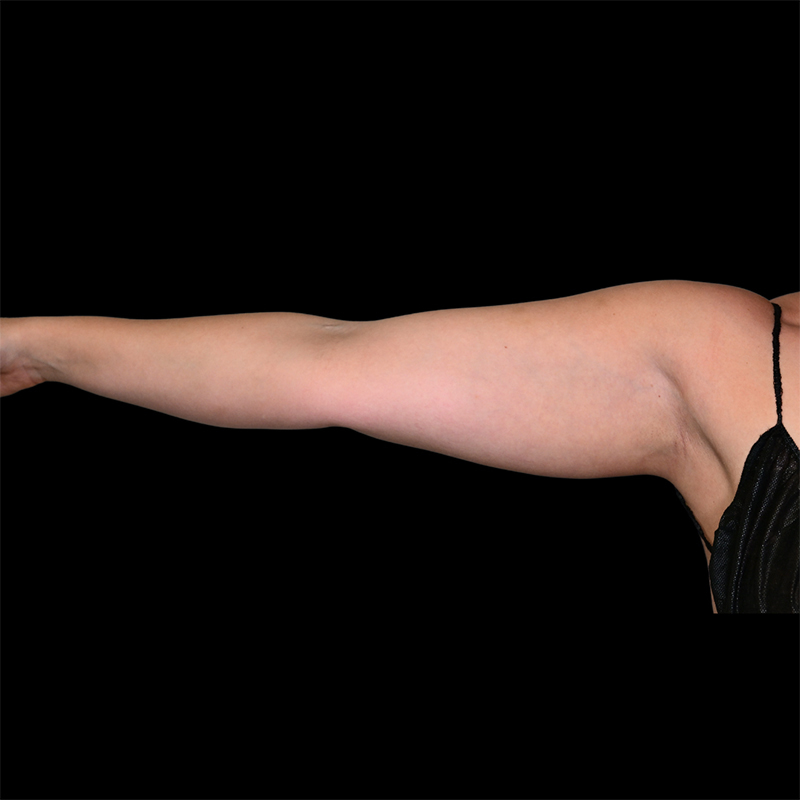 Arm Liposuction Before & After Image