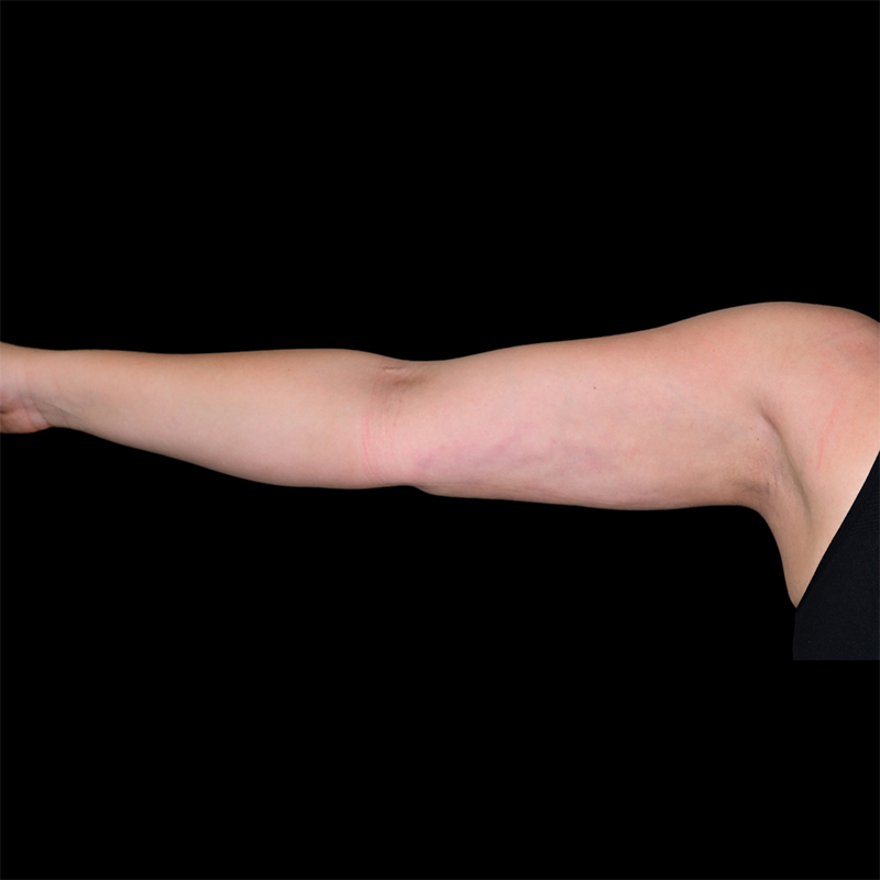 Arm Liposuction Before & After Image