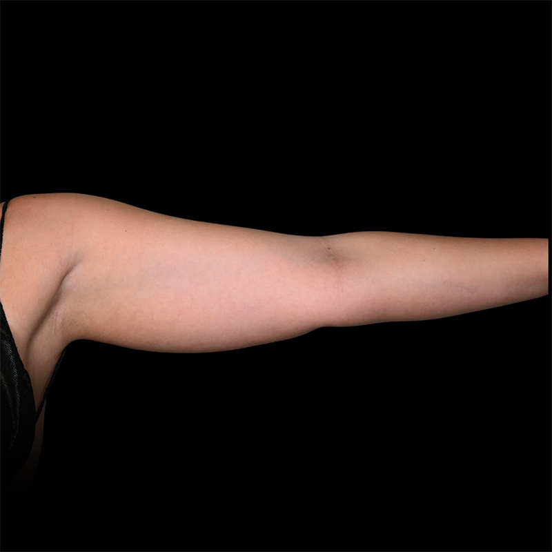 Arm Liposuction Before & After Image