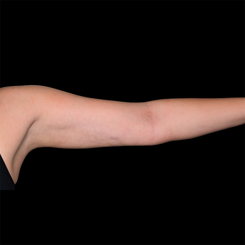 Arm Liposuction Before & After Image