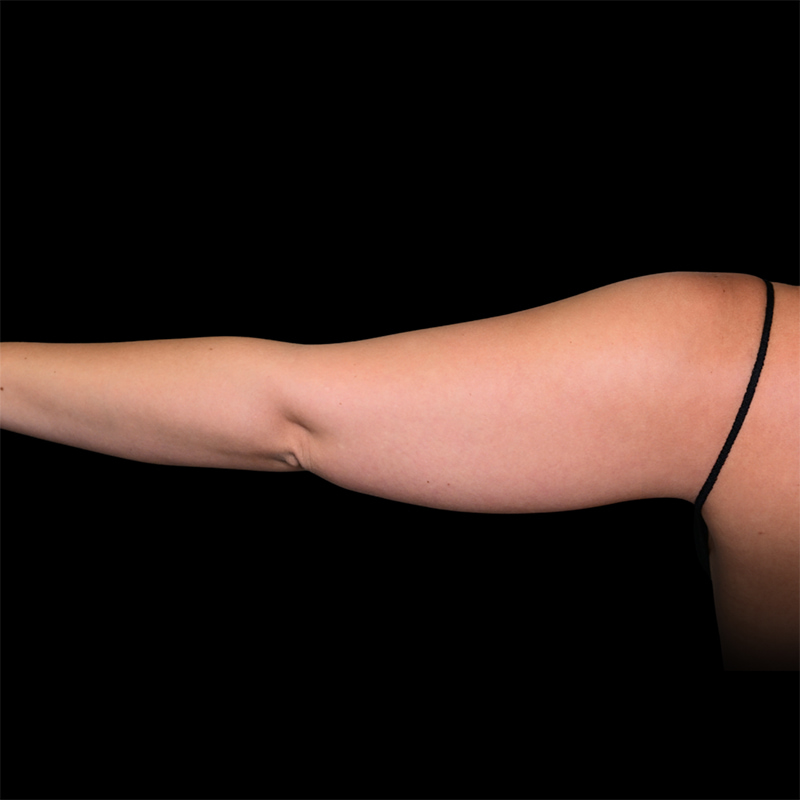 Arm Liposuction Before & After Image