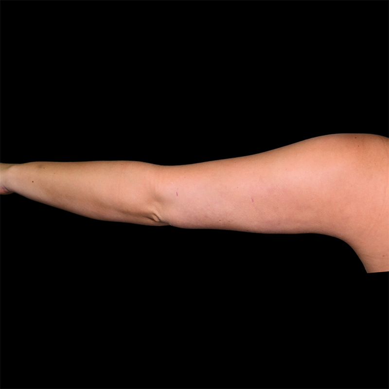 Arm Liposuction Before & After Image