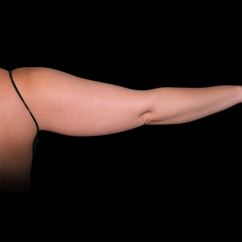 Arm Liposuction Before & After Image