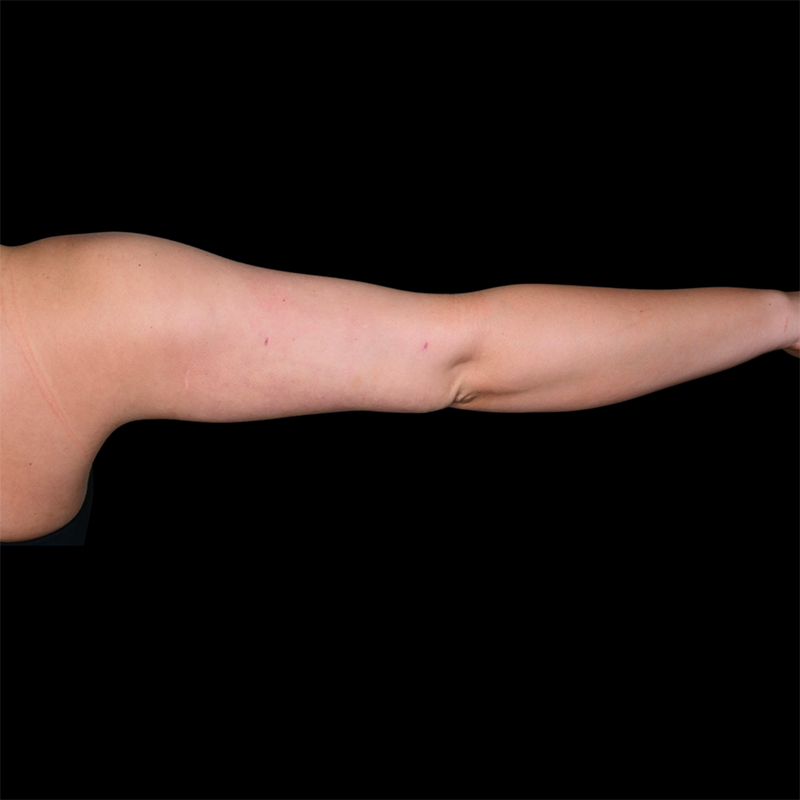 Arm Liposuction Before & After Image