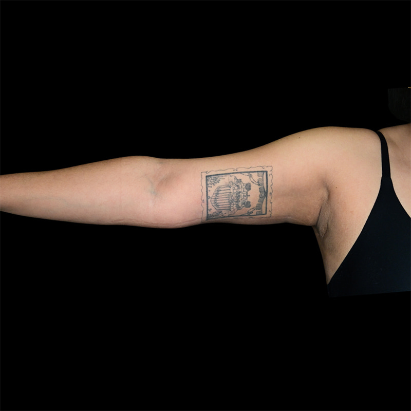 Arm Liposuction Before & After Image