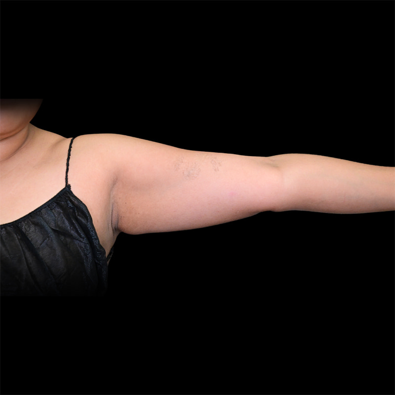 Arm Liposuction Before & After Image