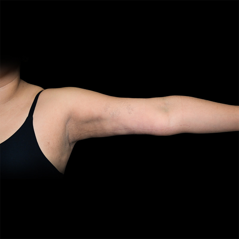 Arm Liposuction Before & After Image