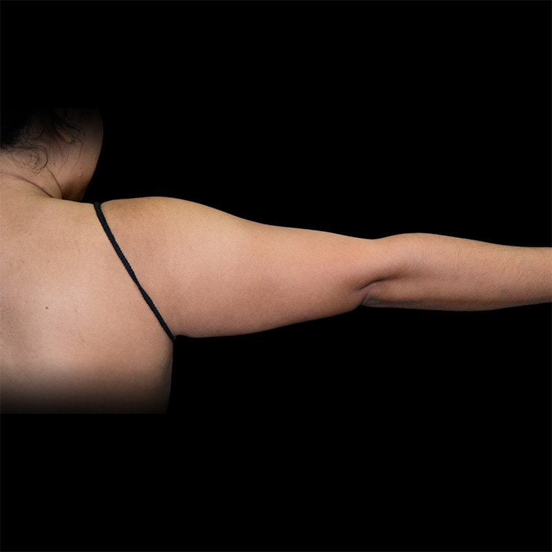 Arm Liposuction Before & After Image