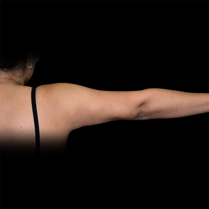 Arm Liposuction Before & After Image