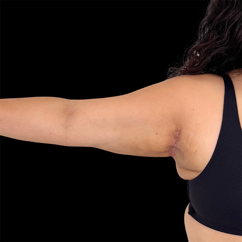 Arm Liposuction Before & After Image
