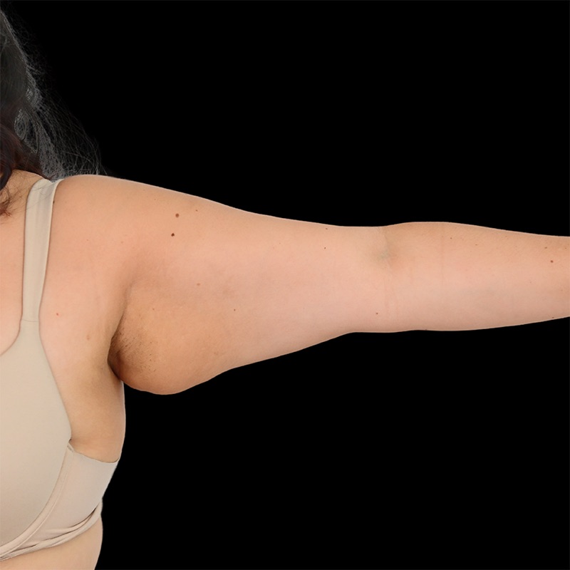 Arm Liposuction Before & After Image