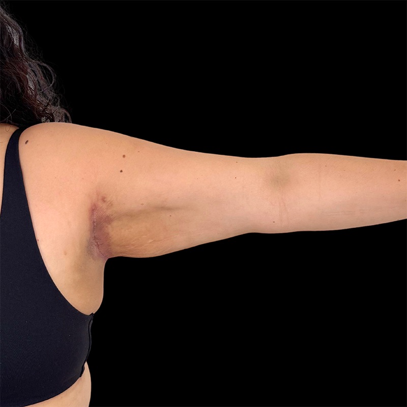 Arm Liposuction Before & After Image
