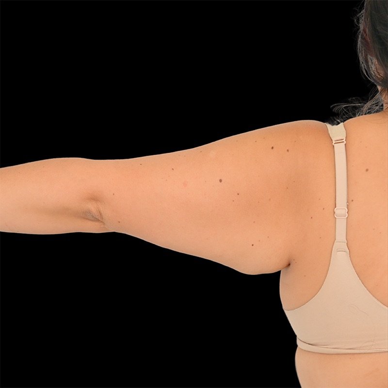 Arm Liposuction Before & After Image