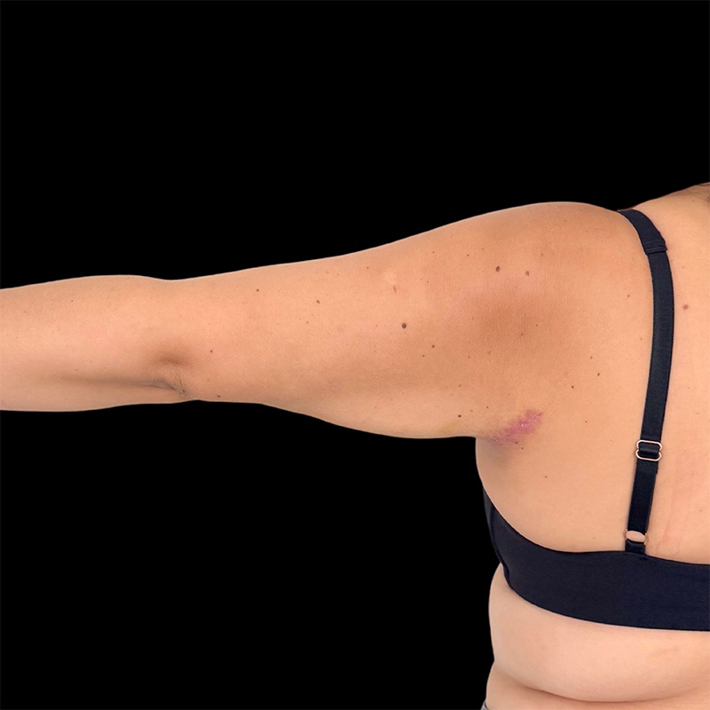Arm Liposuction Before & After Image