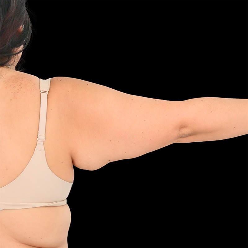 Arm Liposuction Before & After Image