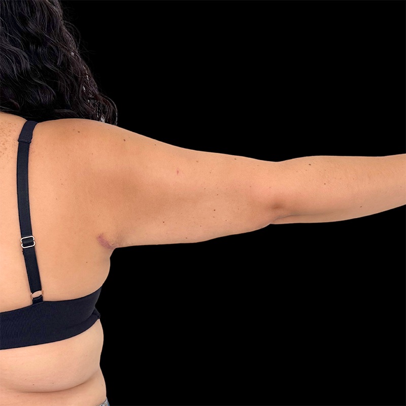 Arm Liposuction Before & After Image