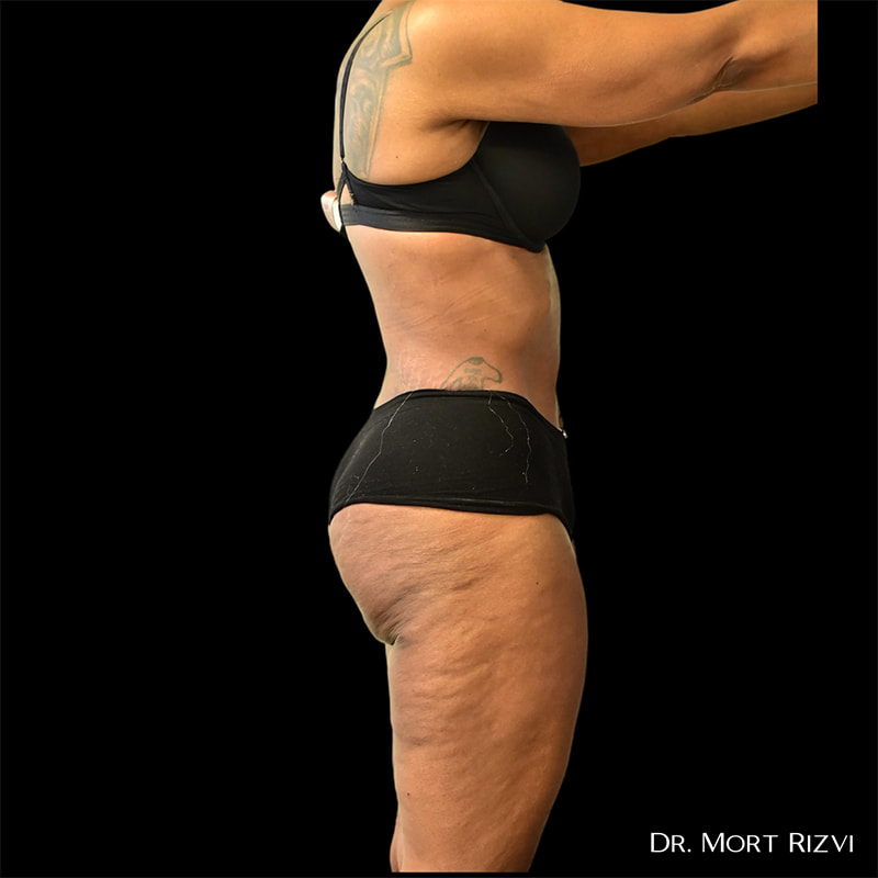 Brazilian Butt Lift Before & After Image