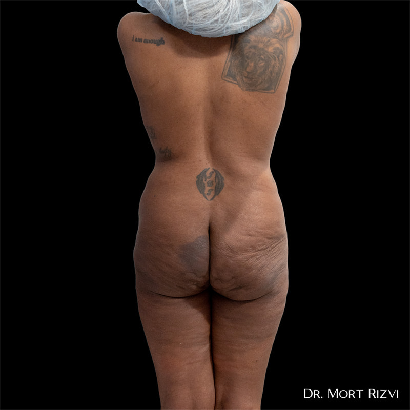 Brazilian Butt Lift Before & After Image