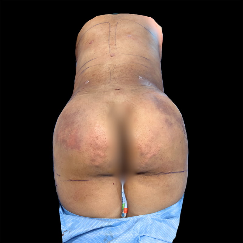 Brazilian Butt Lift Before & After Image