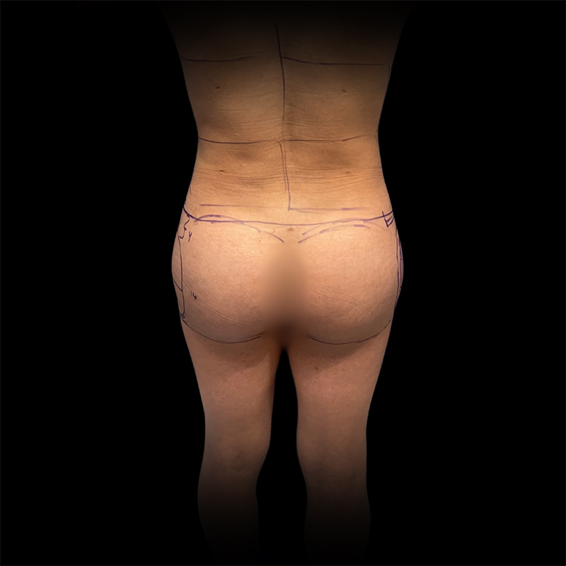 Hip Augmentation Before & After Image