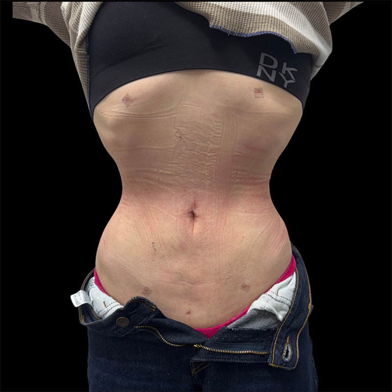 Rib Repositioning Before & After Image