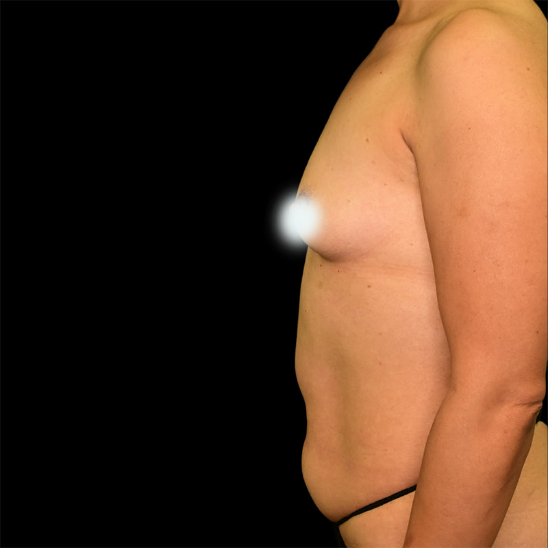 Tummy Tuck Before & After Image