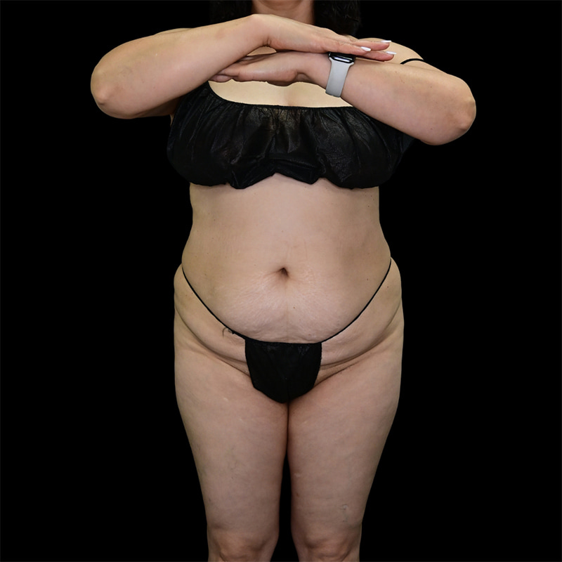 Tummy Tuck Before & After Image