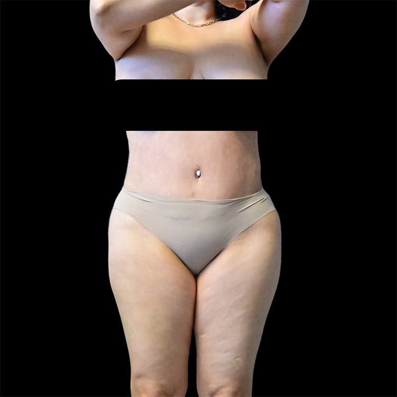 Tummy Tuck Before & After Image