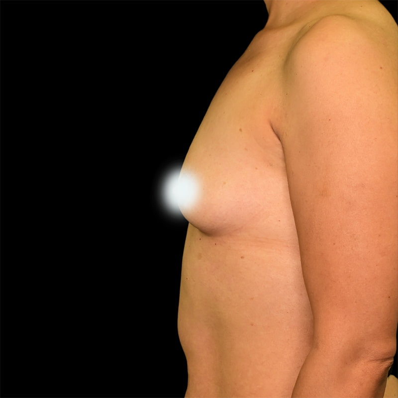 Breast Augmentation Before & After Image