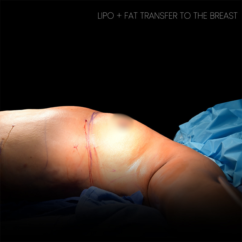 Breast Augmentation Before & After Image