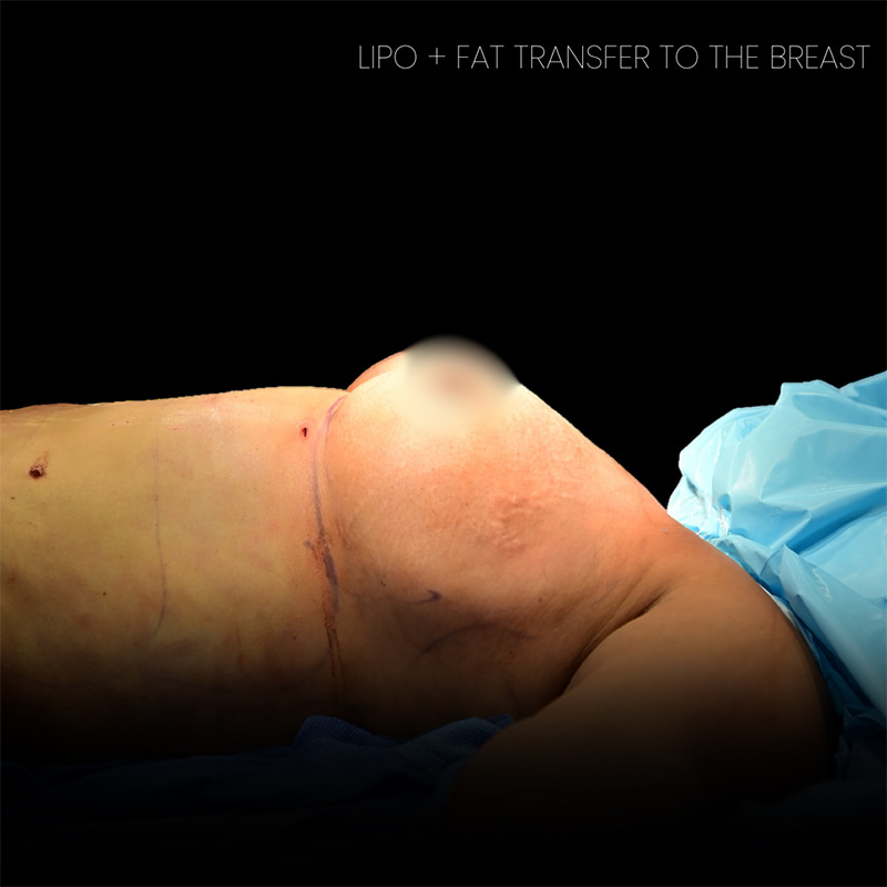 Breast Augmentation Before & After Image