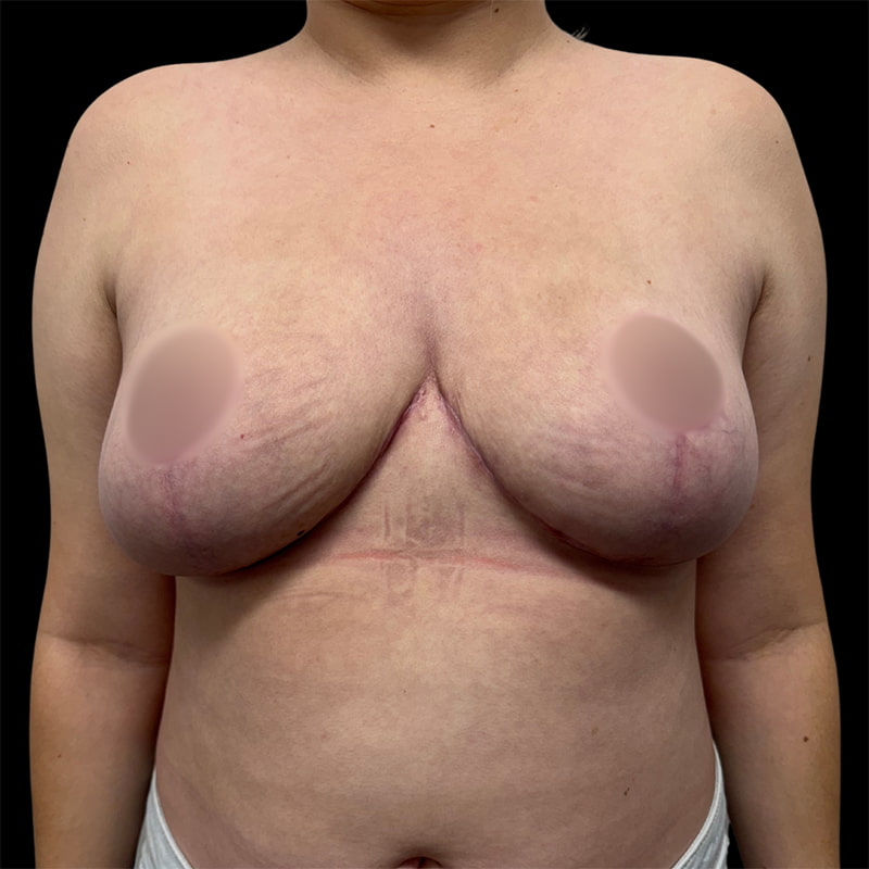 Breast Lift Before & After Image