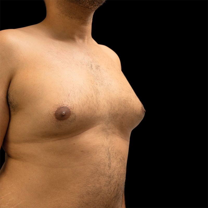 Gynecomastia Before & After Image