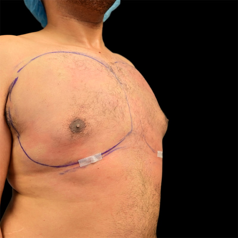 Gynecomastia Before & After Image