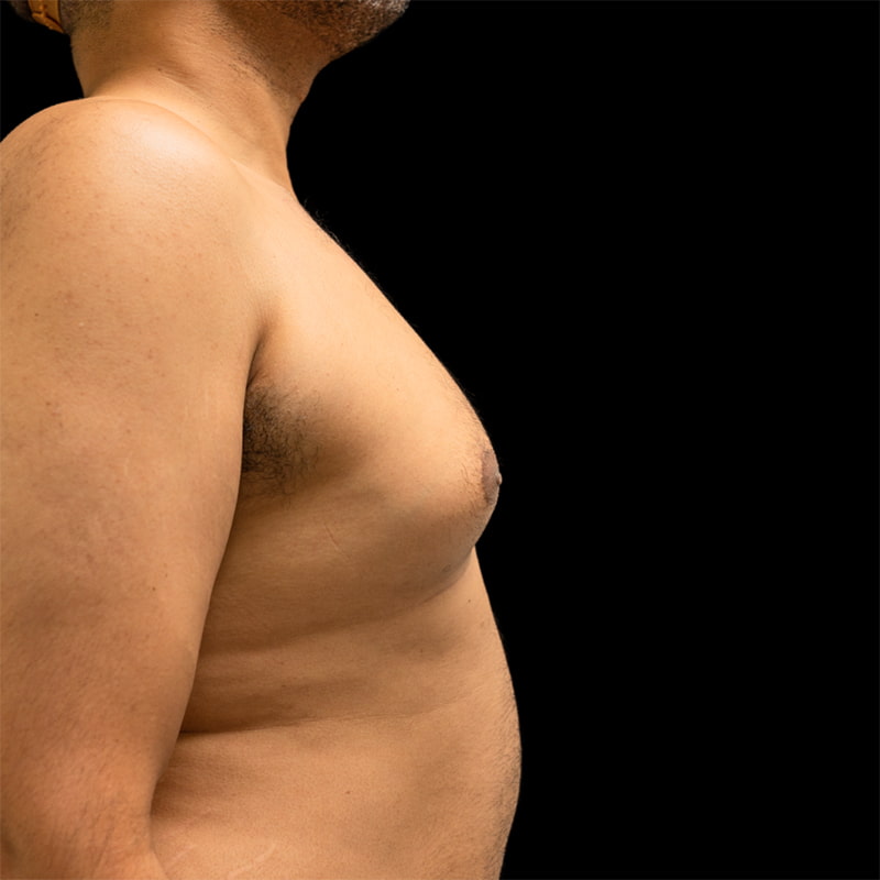 Gynecomastia Before & After Image