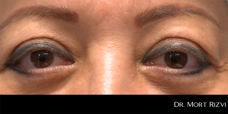 Blepharoplasty Before & After Image