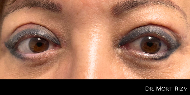 Blepharoplasty Before & After Image