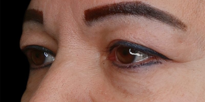 Blepharoplasty Before & After Image