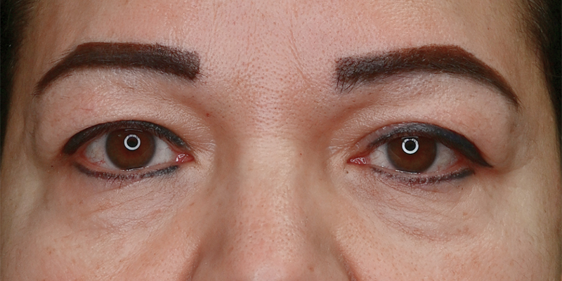 Blepharoplasty Before & After Image