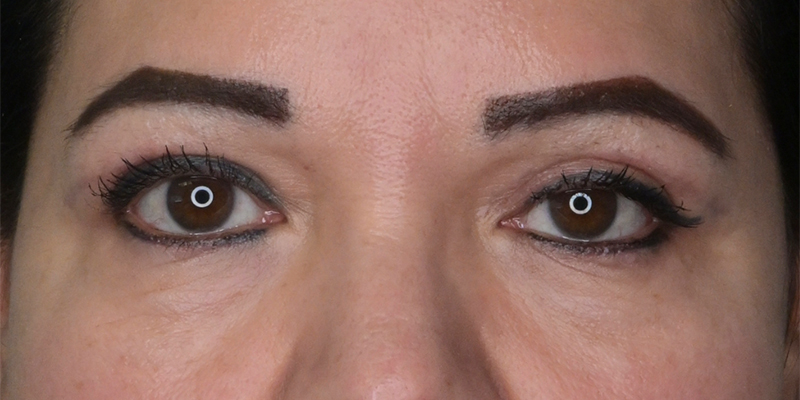 Blepharoplasty Before & After Image