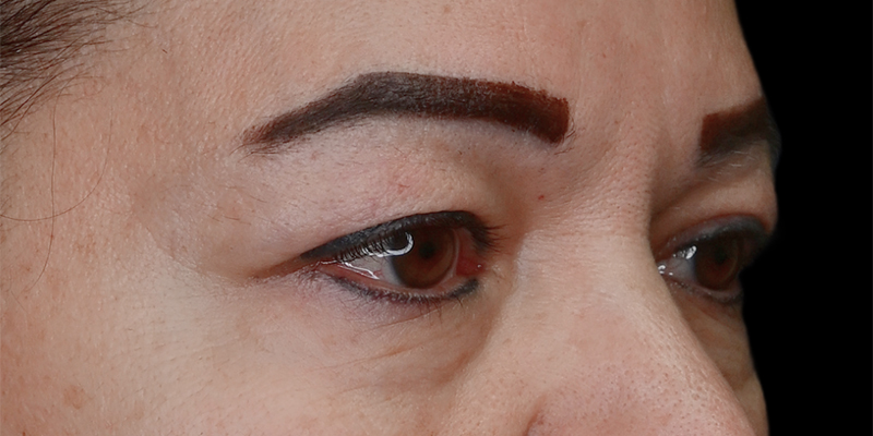 Blepharoplasty Before & After Image